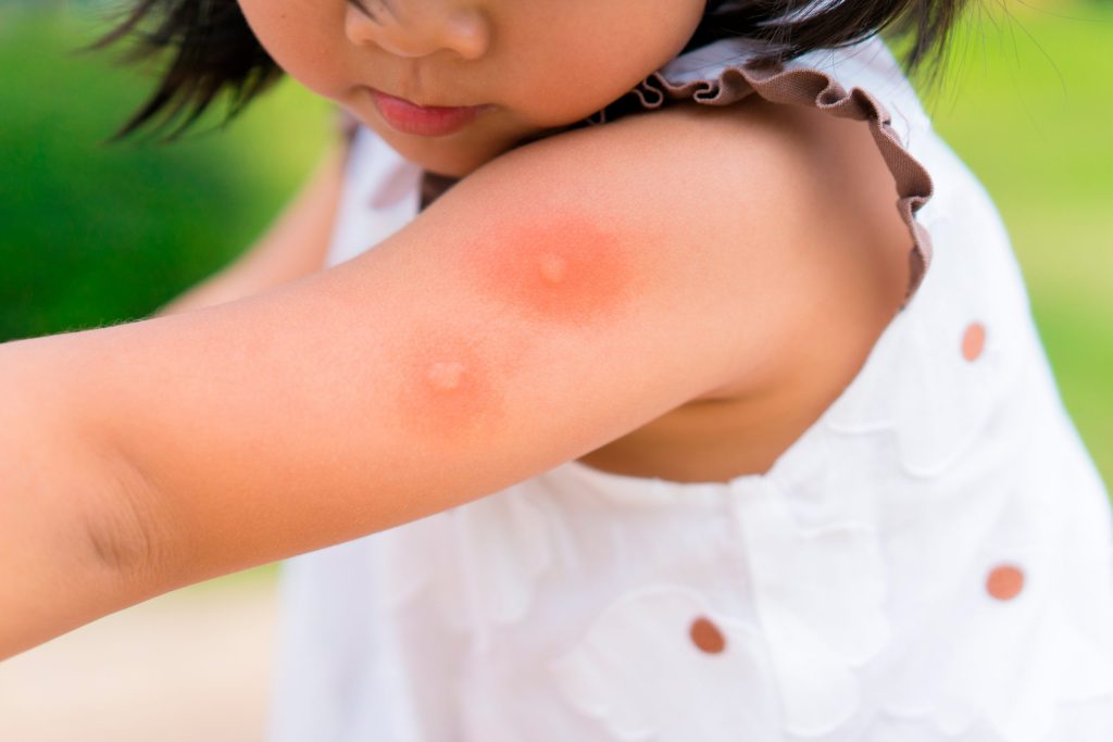 Cómo-saber-si-una-picadura-de-mosquito-es-grave
